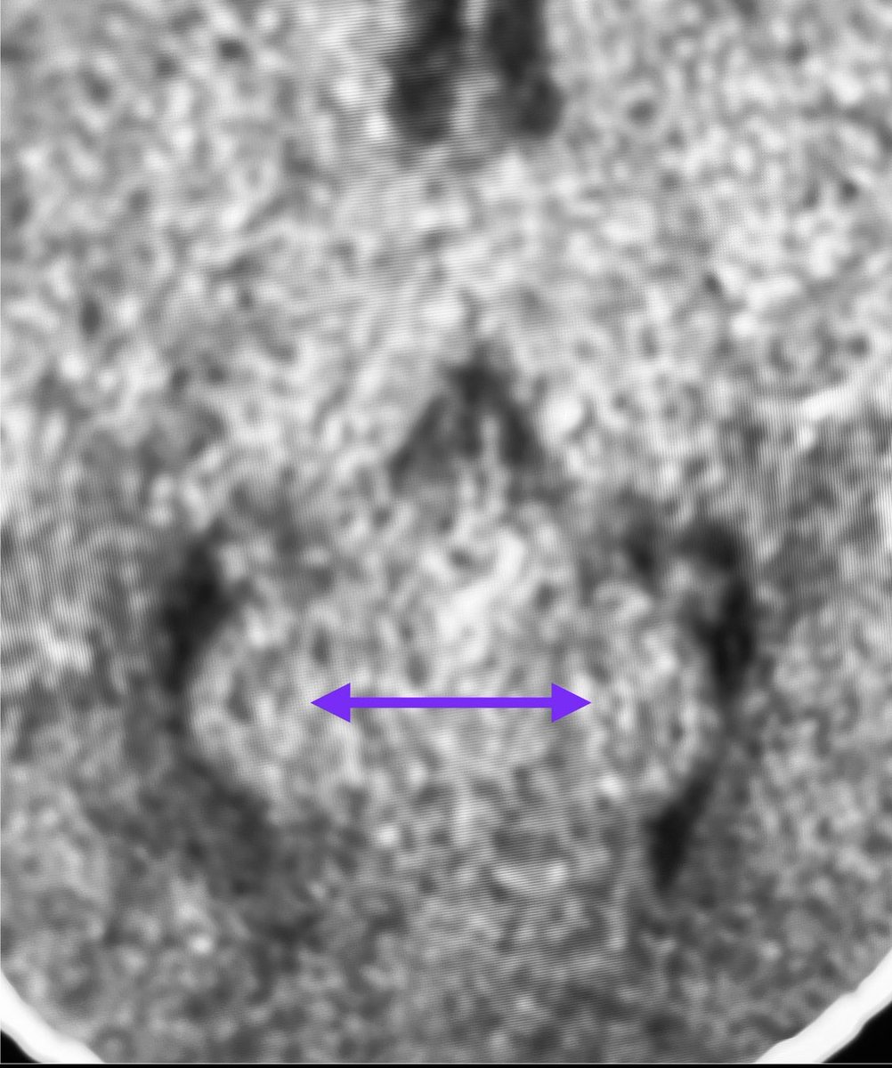 JordiRoldanB's tweet image. 🟣Calcar avis: the white matter that protrudes into the medial aspect of the lateral ventricle, just at the level of the junction trigone-occipital horn. On CT 🧠 don’t confuse it with a malformation of cortical development ✨#Neuroanatomy