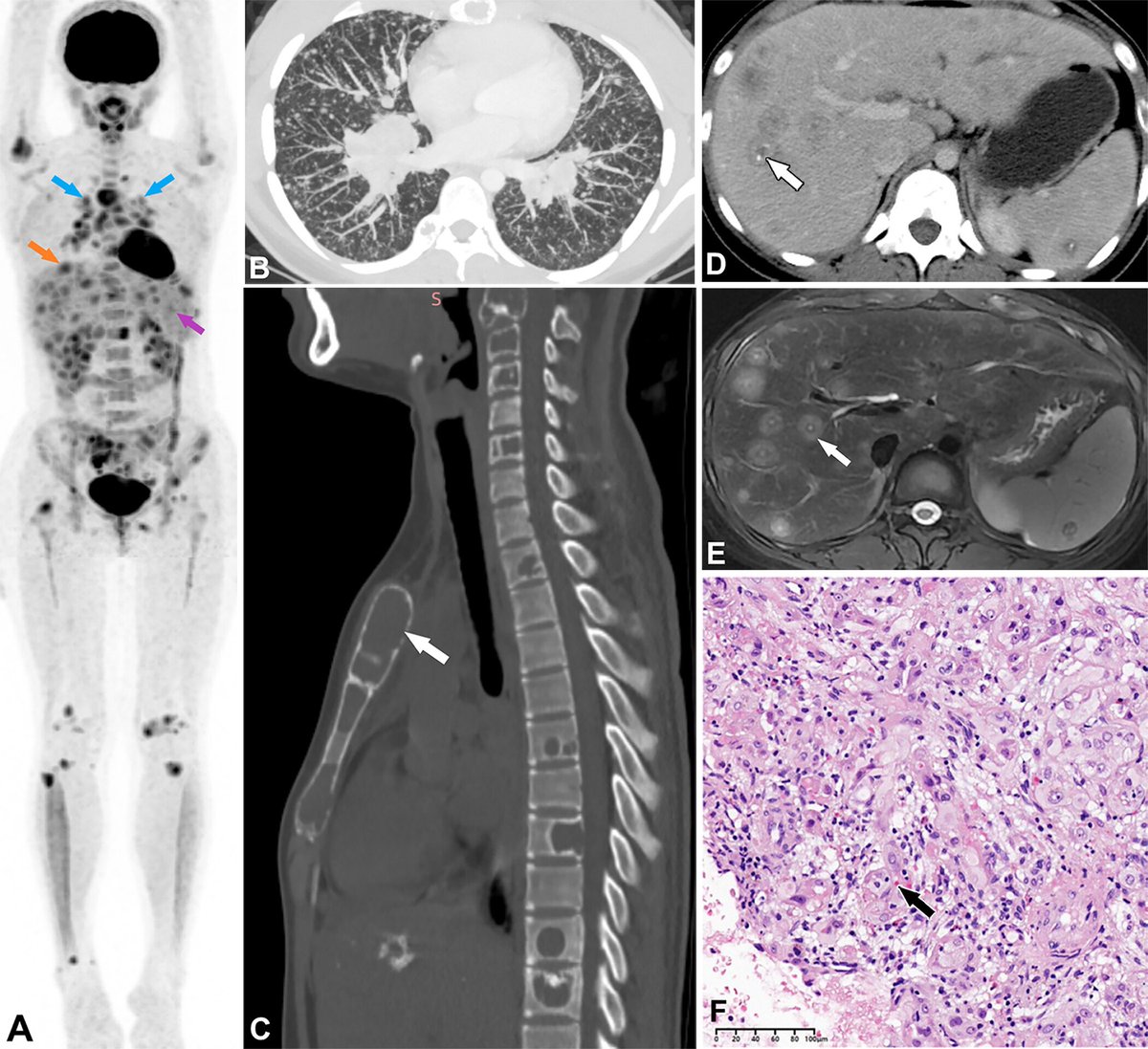 francisdeng's tweet image. A 14yo girl presented with acute on chronic neck pain. A CT neck led to additional imaging below.
Looking at the liver lesions, can you guess the pathology?
Images in 𝑅𝑎𝑑𝑖𝑜𝑙𝑜𝑔𝑦
ANSWER: doi.org/10.1148/radiol…