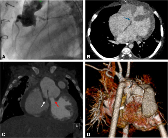 We report a case of simultaneous VAD placement during conversion from single to biventricular repair in the setting of a borderline systemic ventricle - an important technique as a bridge-to-decision, preserving the possibility of biventricular physiology. doi.org/10.1016/j.xjtc…