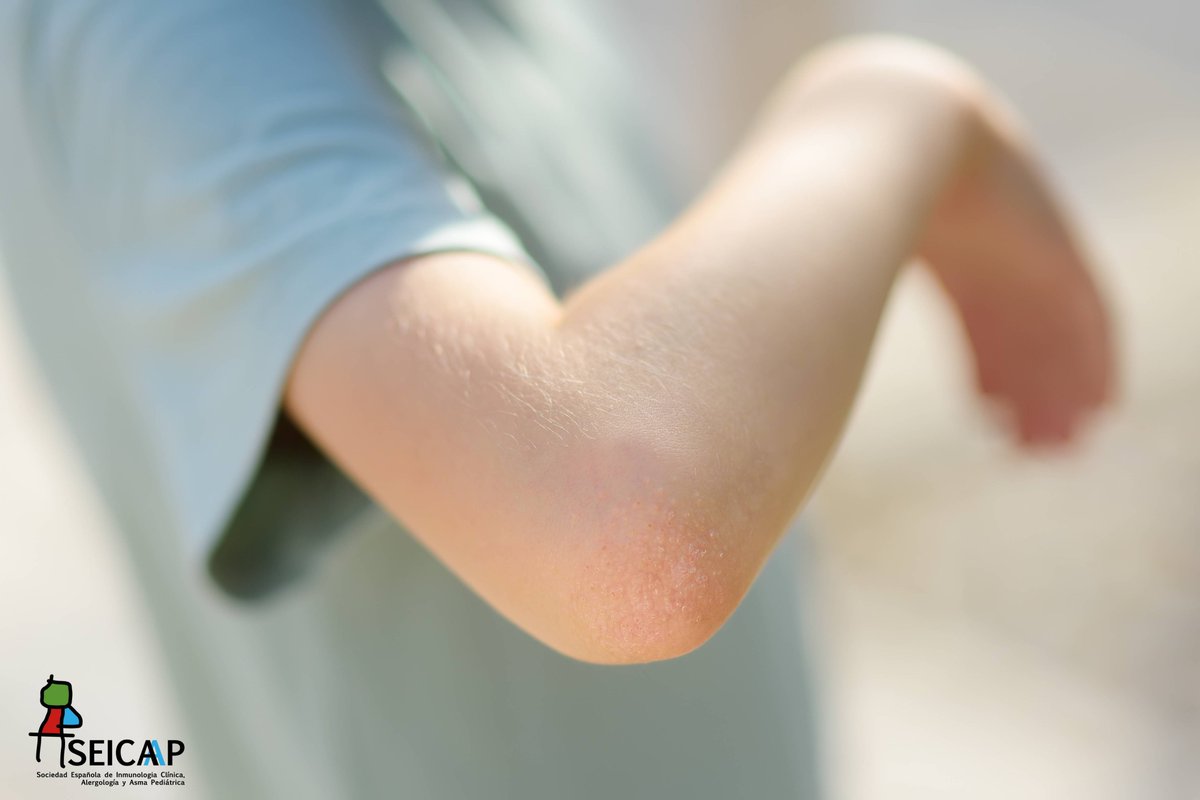 SEICAP's tweet image. 🚿Los niños que sufren dermatitis atópica solo pueden bañarse dos veces a la semana. FALSO❌

Los niños atópicos pueden bañarse diariamente. Se recomienda que sean baños cortos, con agua templada y se debe aplicar crema hidratante seicap.es/desmontando-10…