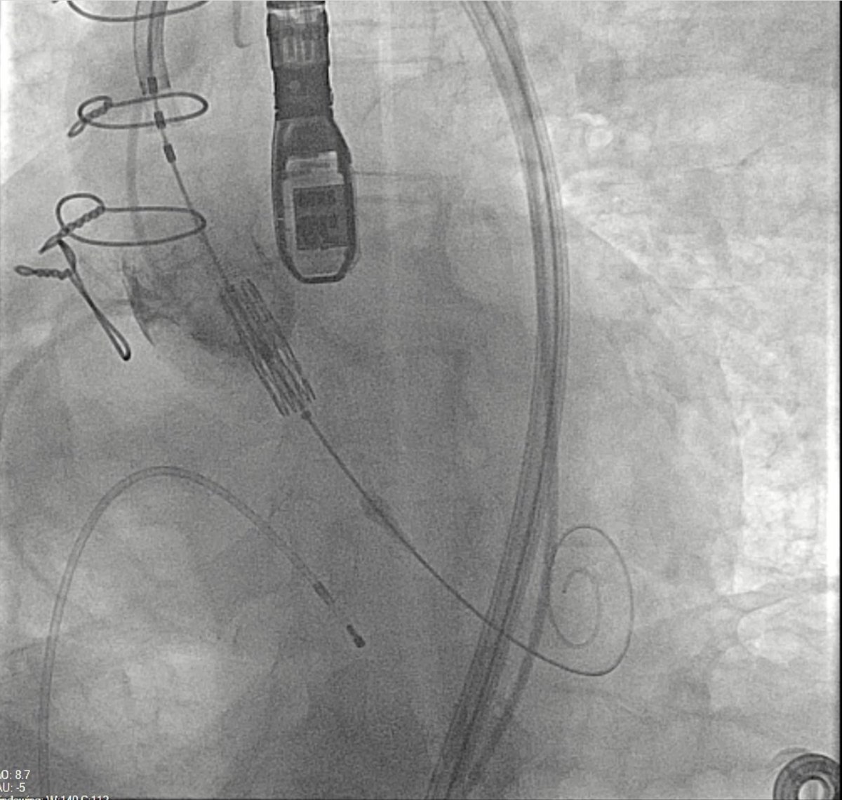 InvasiveCardiol's tweet image. From the July issue: Transcatheter Aortic Valve-in-Valve Implantation in Failed Stentless Valves: A Single-Center Experience ➡️ hubs.ly/Q03xtCPP0
@Takotsubo91 @DLBHATTMD #cardioTwitter #cardioX #cardiology #interventionalcardiology