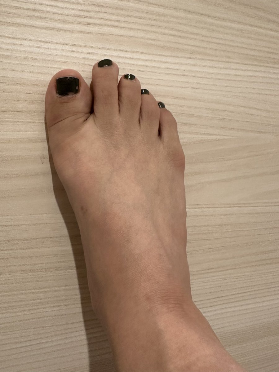 エスワンタイホウ
色素沈着経過観察17
2クール8日目
朝は普通だったのに
服用する時にエスワンタイホウの味で気持ち悪くなりすぐに
盛大に嘔吐してしまいました😥
あの甘い味がトラウマ😱
副作用というより精神的な物なのかな
#抗がん剤
#エスワンタイホウ　#色素沈着
#乳がん　#ルミナールb