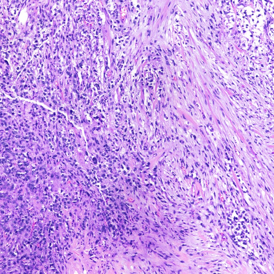 CraigHorbinski's tweet image. Metaplastic transformation of a #glioblastoma is relatively uncommon, but when it happens it&apos;s striking. Like this case, where the #GBM is transforming into bone. #pathology #neuropath #pathtwitter