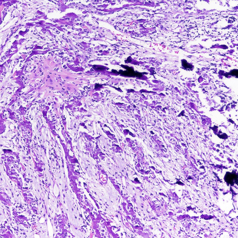 CraigHorbinski's tweet image. Metaplastic transformation of a #glioblastoma is relatively uncommon, but when it happens it&apos;s striking. Like this case, where the #GBM is transforming into bone. #pathology #neuropath #pathtwitter