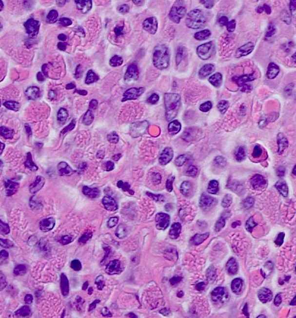 Tiger_heme's tweet image. Gastric MALTOMA with sheets of Russel bodies PCs, almost mimicking Russel body gastritis. Note how it mimics the normal Peyer patches with a secondary reactive follicle - GC in red, mantle zone in orange, marginal zone in aqua and the plasma cells in green.