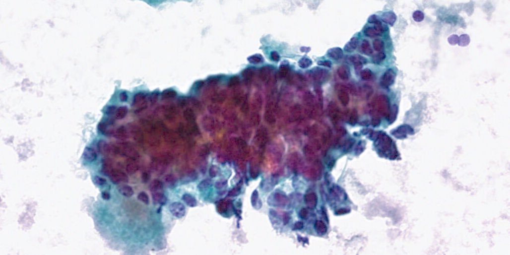 Mauro Saieg, MD, PhD, FIAC (@maurosaieg) on Twitter photo Intrathyroidal thymic carcinoma seen on cytology. <a href="/mdlozanoe/">Lola Lozano</a> <a href="/tlabiano/">Tania Labiano</a> <a href="/TotalCytopath/">Philippe Stephenson, MD</a> <a href="/sza_jhcyto/">Syed Z. Ali</a> <a href="/milyabadli/">Milagros Abad-Licham</a>
✅ spindle cell morphology, occasionally showing queratinization
✅ 3D tissue fragments with moderate atypia
✅ CD5 and CKIT positivity on cell blocks. Intrathyroidal thymic carcinoma seen on cytology. <a href="/mdlozanoe/">Lola Lozano</a> <a href="/tlabiano/">Tania Labiano</a> <a href="/TotalCytopath/">Philippe Stephenson, MD</a> <a href="/sza_jhcyto/">Syed Z. Ali</a> <a href="/milyabadli/">Milagros Abad-Licham</a>
✅ spindle cell morphology, occasionally showing queratinization
✅ 3D tissue fragments with moderate atypia
✅ CD5 and CKIT positivity on cell blocks.