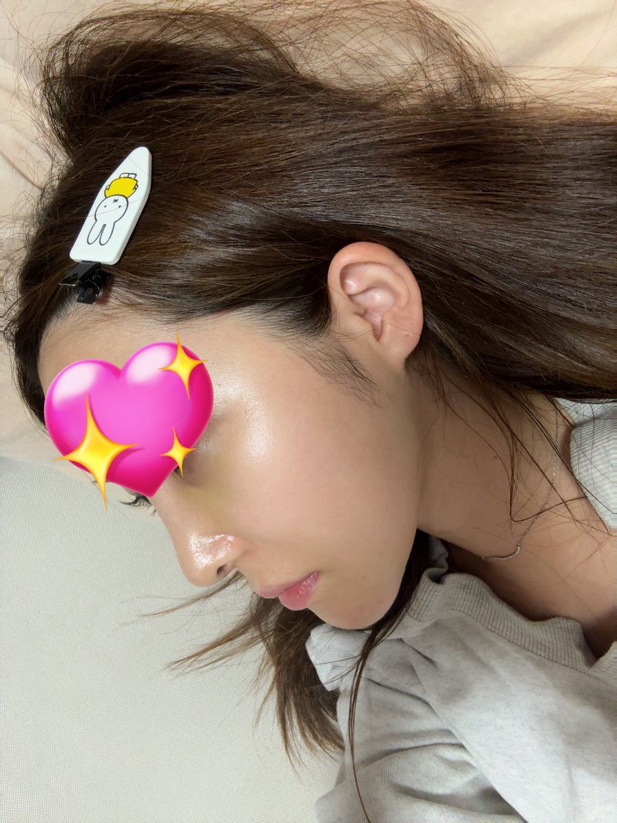meronchannasan's tweet photo. 鼻整形して1ヶ月経ちました😌

#ビギン美容外科 #鼻整形 #鼻フル #整形垢 #韓国整形 #begin_ps #イジュチョル院長 https://t.co/el7eAkmmhO