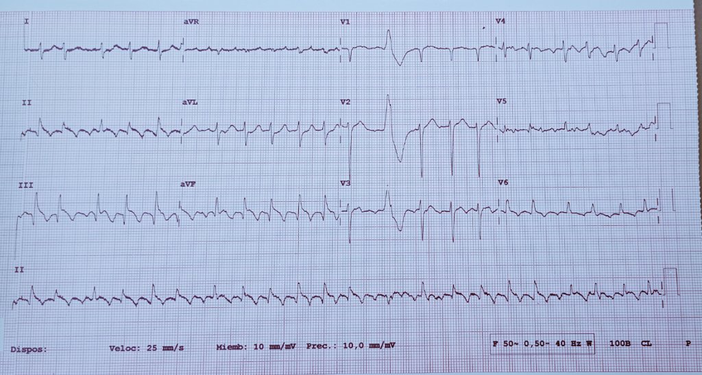 60 yo male patient in the ICU after SAVR... What is the rhythm present on this trace?