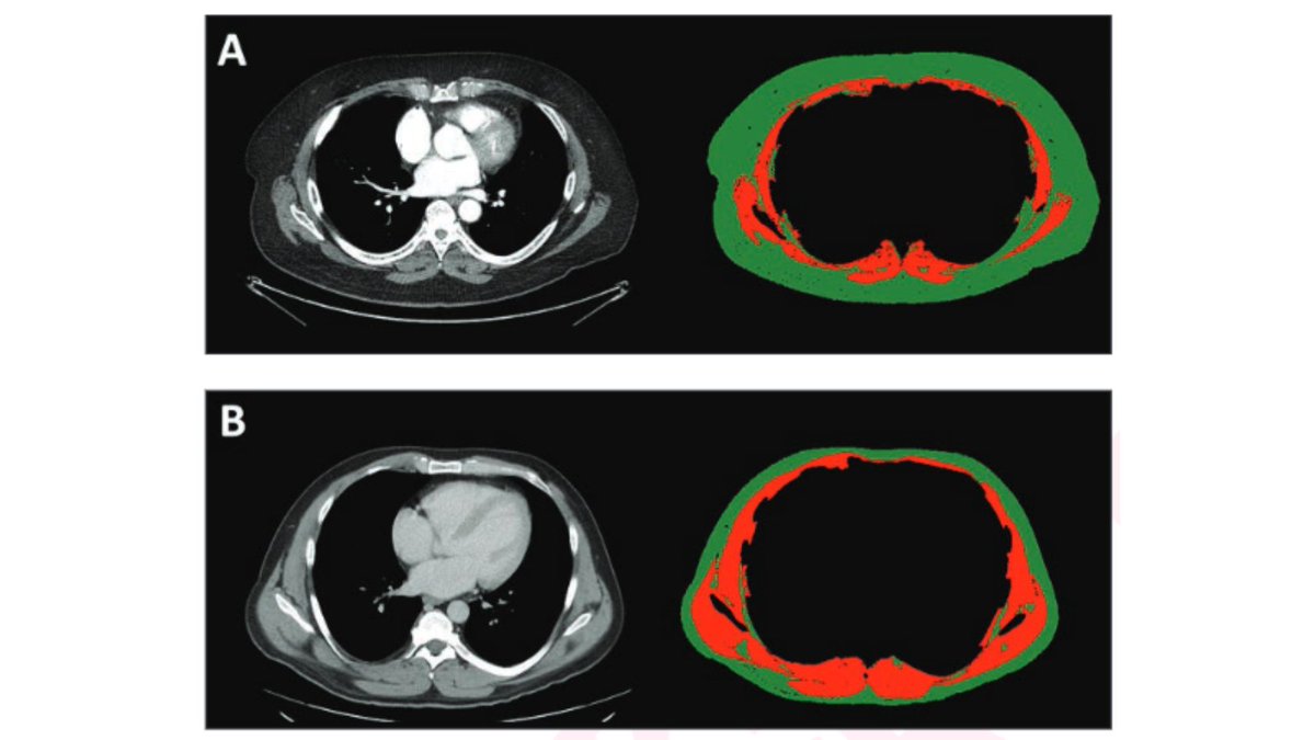 arosenkrantzmd's tweet image. New @AJR_Radiology Accepted Manuscript:
"Opportunistic Screening on Chest CT, From the AJR Special Series on Screening"
By Drs Theure, Fintelmann, & team @MGHImaging
ajronline.org/doi/10.2214/AJ…