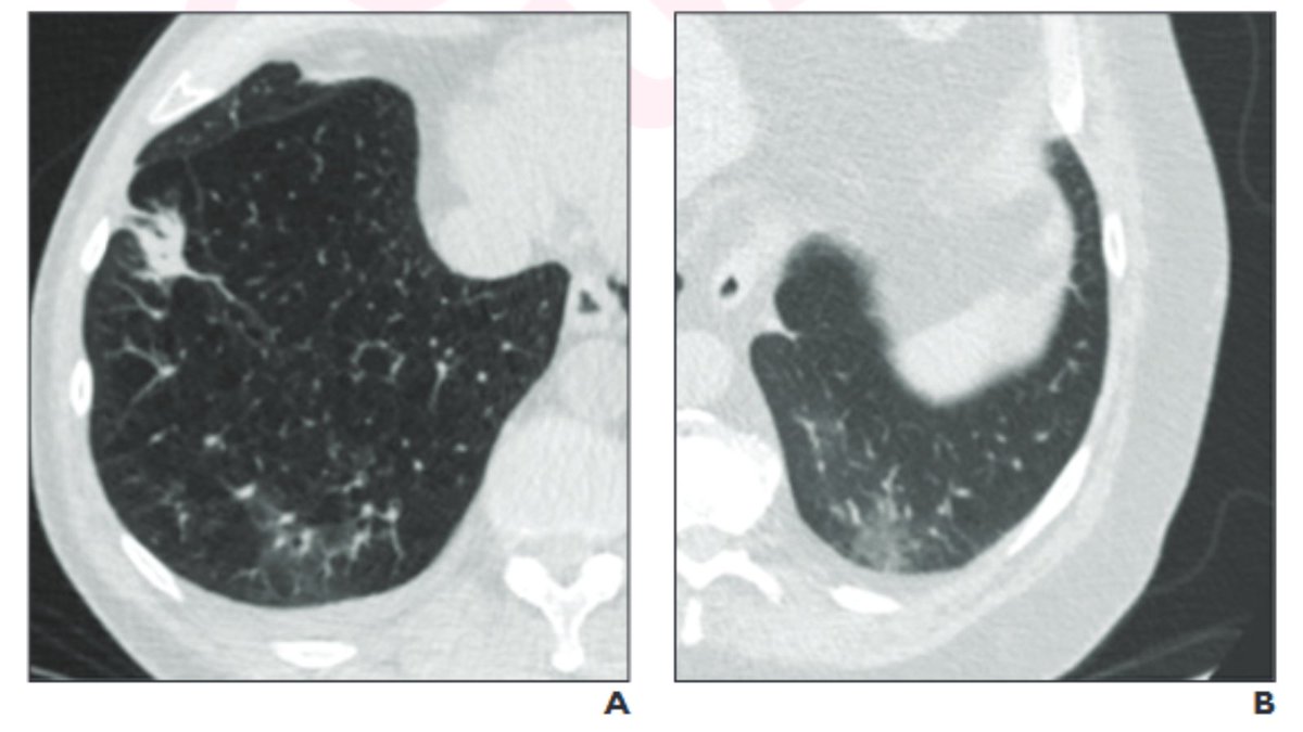 arosenkrantzmd's tweet image. New @AJR_Radiology Accepted Manuscript:
"Real-World Use and Outcomes of Lung-Rads v1.1 Category 4B Versus v2022 Category 0 for Suspected Infectious or Inflammatory Findings on Lung Cancer Screening CT"
By Drs Arora, Hammer, & @scbyrne2 @BrighamRad
ajronline.org/doi/10.2214/AJ…