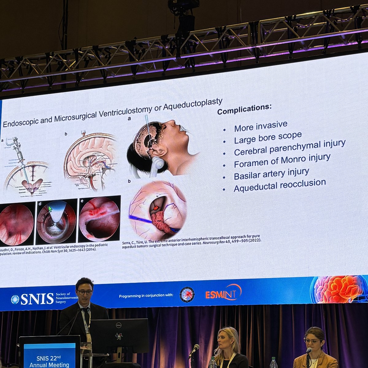 JNIS (@jnis_bmj) on Twitter photo Dr. Serdar Rahmanov is presenting on a novel neurointerventional aqueductoplasty technique for the treatment of aqueductal stenosis. #SNIS2025 @SNISInfo <a href="/esmintsociety/">ESMINT Society</a> <a href="/cvsection/">CV Section</a> <a href="/fcalbuquerque51/">Felipe C. Albuquerque</a> <a href="/dr_mchen/">Michael Chen, MD</a> <a href="/DanniDiestro/">Dr. DiestroKE</a> <a href="/MattAmansMD/">Matthew Amans</a> <a href="/ducruetaf/">Andrew Ducruet</a> <a href="/MattFusco_MD/">Matt Fusco</a> <a href="/DrAltschul/">Dorothea Altschul MD FAHA FSVIN</a> Dr. Serdar Rahmanov is presenting on a novel neurointerventional aqueductoplasty technique for the treatment of aqueductal stenosis. #SNIS2025 @SNISInfo <a href="/esmintsociety/">ESMINT Society</a> <a href="/cvsection/">CV Section</a> <a href="/fcalbuquerque51/">Felipe C. Albuquerque</a> <a href="/dr_mchen/">Michael Chen, MD</a> <a href="/DanniDiestro/">Dr. DiestroKE</a> <a href="/MattAmansMD/">Matthew Amans</a> <a href="/ducruetaf/">Andrew Ducruet</a> <a href="/MattFusco_MD/">Matt Fusco</a> <a href="/DrAltschul/">Dorothea Altschul MD FAHA FSVIN</a>