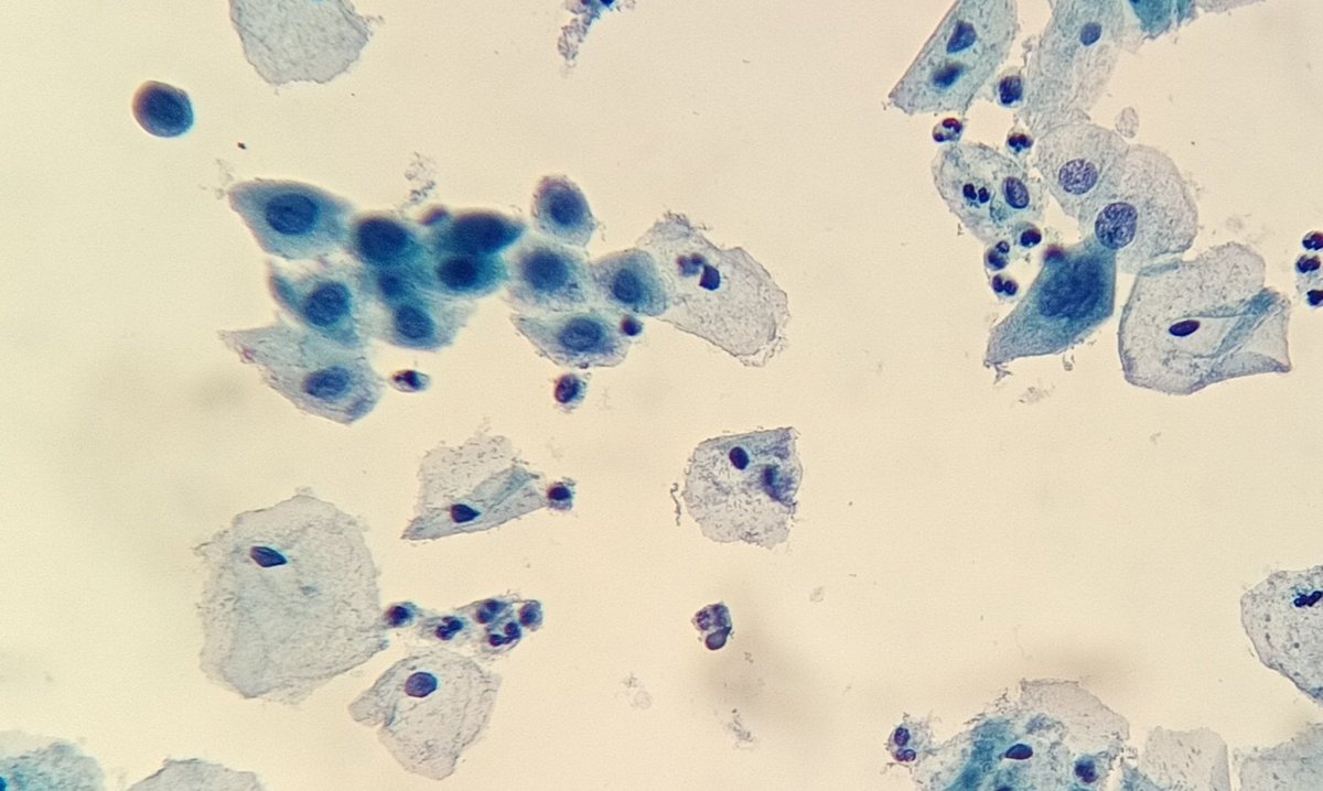 gemamoreno91's tweet image. HSIL#Gynecological cytology# Pathology