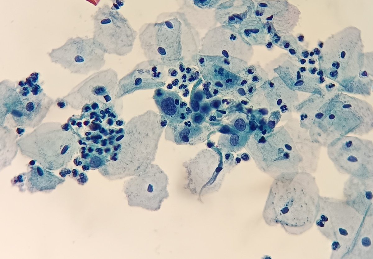 gemamoreno91's tweet image. HSIL#Gynecological cytology# Pathology