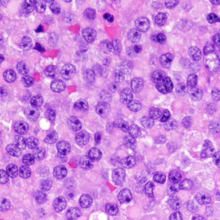 CraigHorbinski's tweet image. Impressive CAM5.2-positive fibrous bodies in a sparsely granulated PIT-1 pituitary adenoma (a.k.a. PitNET). If you look carefully, you can see them on the corresponding H&amp;amp;E. #pathology #neuropath #pathtwitter
