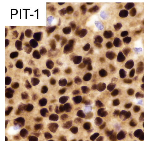 CraigHorbinski's tweet image. Impressive CAM5.2-positive fibrous bodies in a sparsely granulated PIT-1 pituitary adenoma (a.k.a. PitNET). If you look carefully, you can see them on the corresponding H&amp;amp;E. #pathology #neuropath #pathtwitter