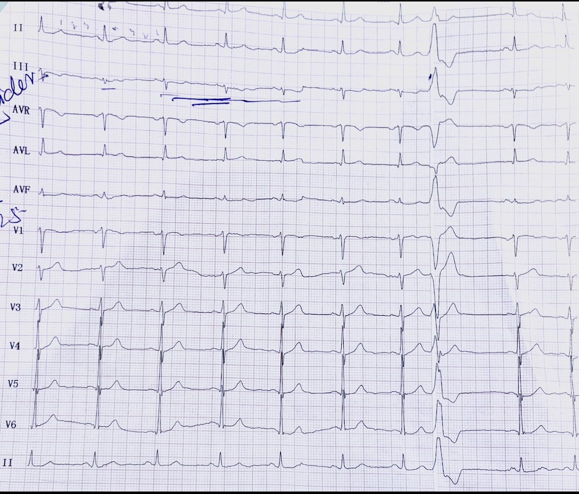 Typical chest pain
What do u see?