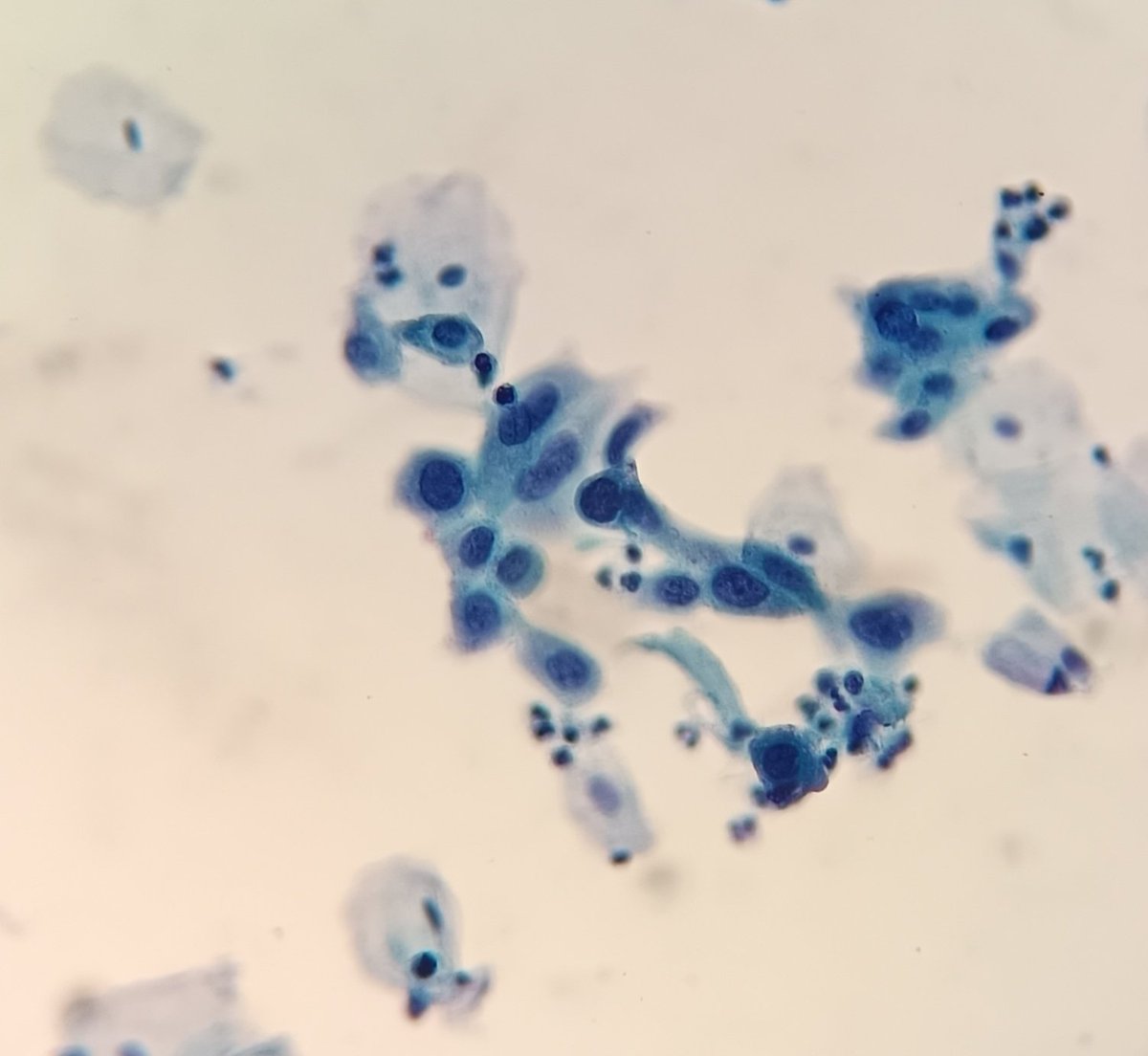gemamoreno91's tweet image. HSIL#Gynecological cytology# Pathology