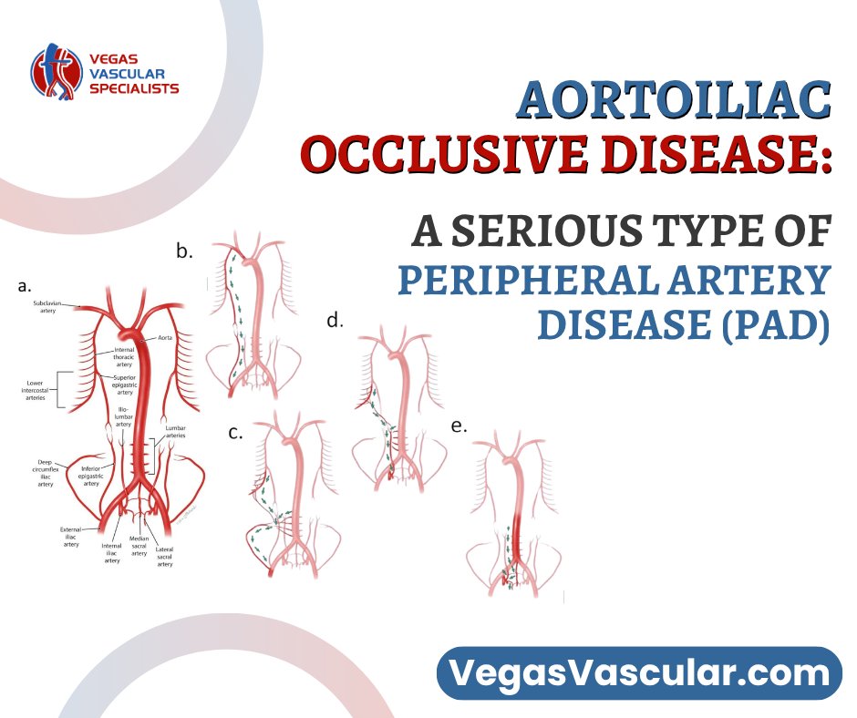 Aortoiliac occlusive disease is a form of peripheral artery disease (PAD) caused by plaque buildup in the lower aorta and iliac arteries, reducing blood flow to the legs and pelvis.

Read the full article here: vegasvascular.com/aortoiliac-occ…