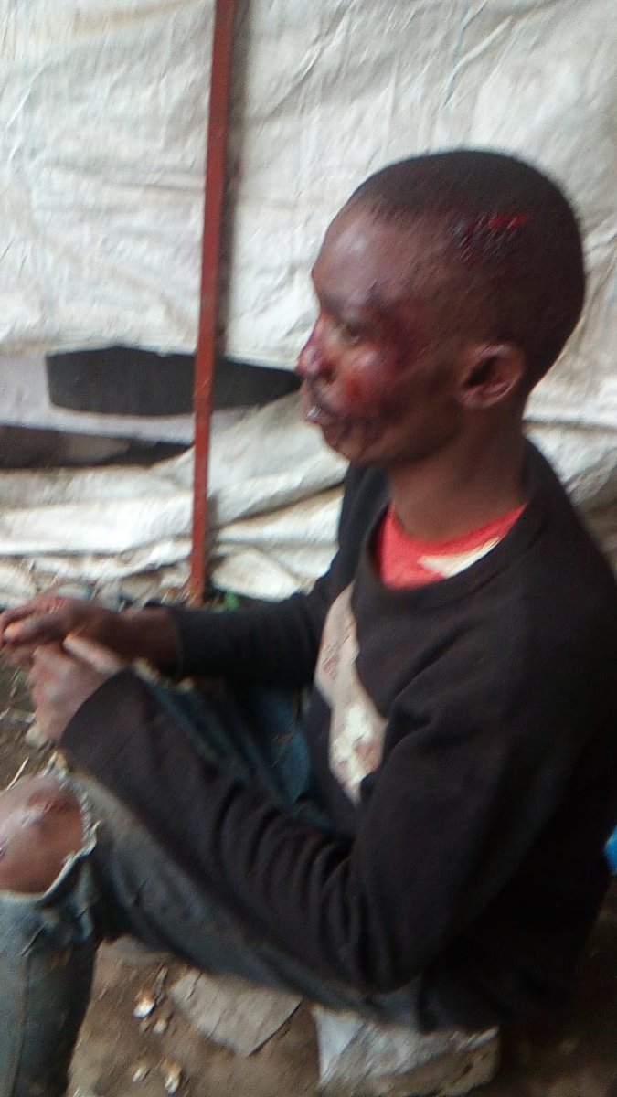 MathareSJustice's tweet image. Huruma Police beat up those arrested on 7/7/25, after asking for food and water. This young man was beaten and later released when they realized the injuries were grave. The courts too, have become complicit as they are working with the state to extend the illegal detention.