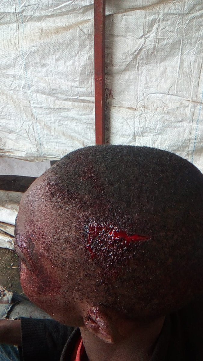 MathareSJustice's tweet image. Huruma Police beat up those arrested on 7/7/25, after asking for food and water. This young man was beaten and later released when they realized the injuries were grave. The courts too, have become complicit as they are working with the state to extend the illegal detention.