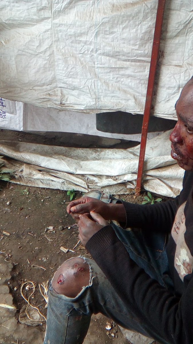 MathareSJustice's tweet image. Huruma Police beat up those arrested on 7/7/25, after asking for food and water. This young man was beaten and later released when they realized the injuries were grave. The courts too, have become complicit as they are working with the state to extend the illegal detention.