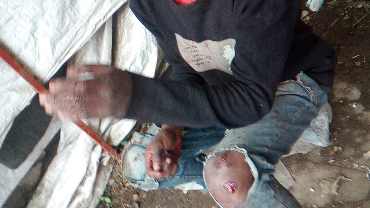 MathareSJustice's tweet image. Huruma Police beat up those arrested on 7/7/25, after asking for food and water. This young man was beaten and later released when they realized the injuries were grave. The courts too, have become complicit as they are working with the state to extend the illegal detention.