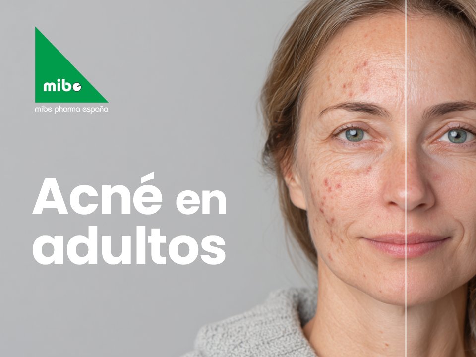 🌿 El acné en adultos no es solo un problema estético.  🧬Las hormonas, el estrés y ciertos hábitos lo mantienen activo más allá de la adolescencia.  👩‍⚕️Con el tratamiento adecuado, es posible recuperar el equilibrio y la confianza.

👉 Lee más aquí: mibepharma.com/es/patologia-t…