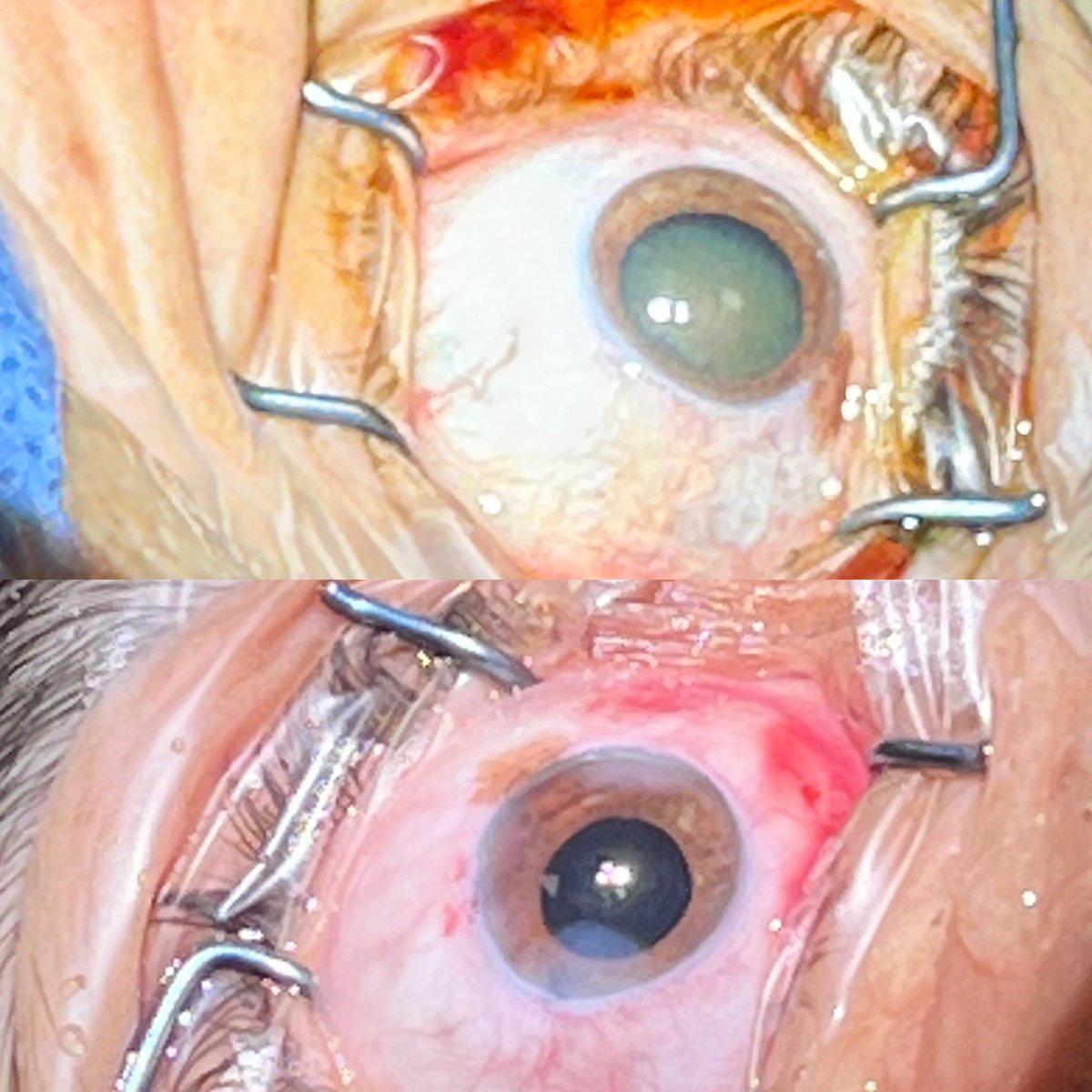 Günün 7. ve son vakası 
Son evreye gelmiş, zonül zaafiyeti olan matür katarakt. Ameliyatı başarıyla tamamladık ama siz kendinizin ve yakınlarınızın kataraktlarını bu kadar bekletmeyin. Risk oranı nispeten daha normal kataraktlara göre çok daha yüksek. 
Mutlaka düzenli göz