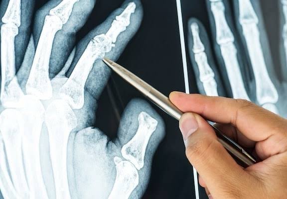 Aravind Palraj (@rheumat_aravind) on Twitter photo 🧵 “10 Rheumatology Radiology Clues Every Clinician Should Recognize”
Imaging can make or break the diagnosis.
Here are 10 classic radiologic findings in rheumatology to know 👇
#Rheumatology #MedTwitter #ClinicalPearls #Radiology <a href="/DrAkhilX/">Dr. Akhil 🇮🇳</a> <a href="/IhabFathiSulima/">Dr Ihab Suliman</a> <a href="/Janetbirdope/">Janet Pope</a> 🧵 “10 Rheumatology Radiology Clues Every Clinician Should Recognize”
Imaging can make or break the diagnosis.
Here are 10 classic radiologic findings in rheumatology to know 👇
#Rheumatology #MedTwitter #ClinicalPearls #Radiology <a href="/DrAkhilX/">Dr. Akhil 🇮🇳</a> <a href="/IhabFathiSulima/">Dr Ihab Suliman</a> <a href="/Janetbirdope/">Janet Pope</a>