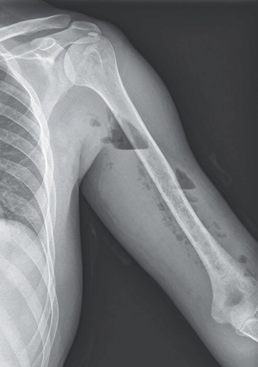 drsthanus's tweet photo. 37-year-old man presented to the ED with a 1-wk hx of pain and swelling in the left upper arm that had started after blunt trauma during soccer practice.

Likely diagnosis? https://t.co/LiM1VvnQXv