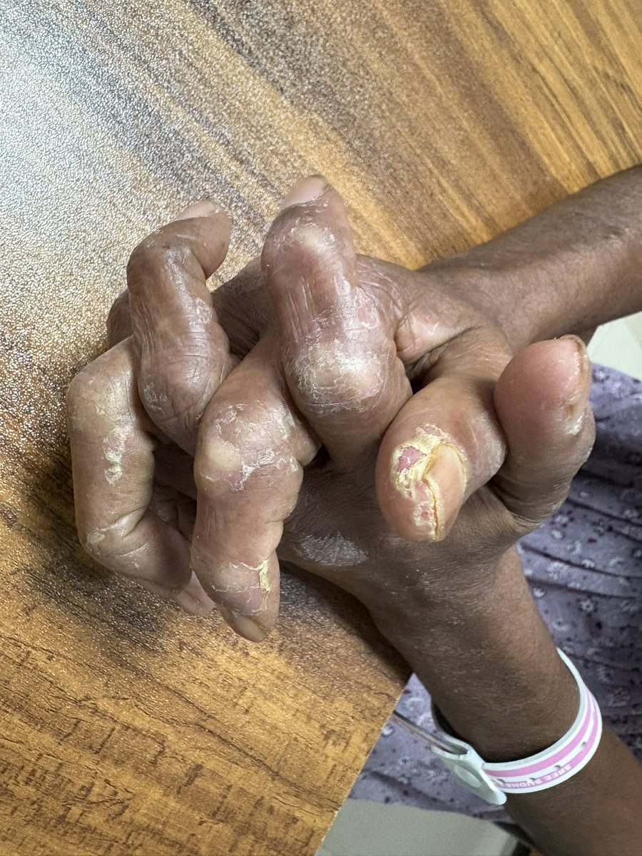 Painful thickened cracked skin on the sides of fingers and palms in a lady with Anti-synthetase syndrome and dermatomyositis- s/o Mechanic’s hands

🧠  Features of Mechanic’s hands
Hyperkeratotic, fissured plaques on the radial sides of the index fingers and thumbs
↘️Cracked,