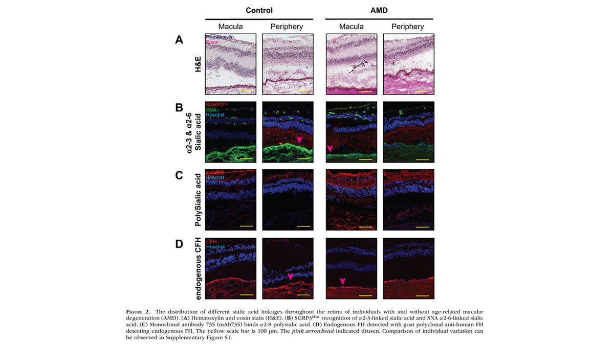 CzerwinsMarcin's tweet image. Another interesting paper form Pascal Gagneux. The sialome of human retina is altered in AMD, which may affect binding of complement factor F, and, consequently, alternative complement pathway regulation.
tinyurl.com/2fzw4wxk
#glycotime