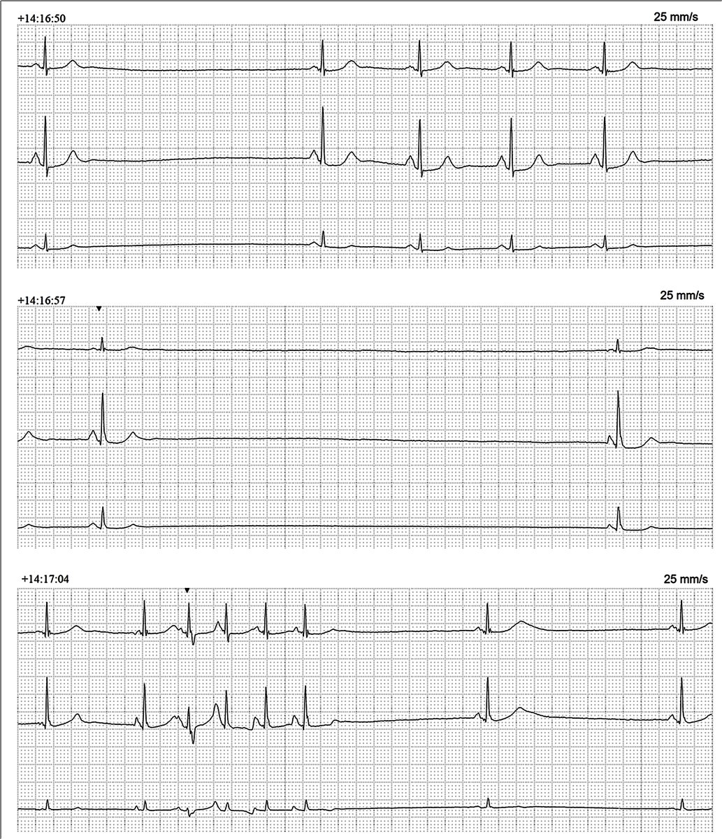Please explain these 3 continuous Holter-strips from an elderly woman with palpitations and dizziness