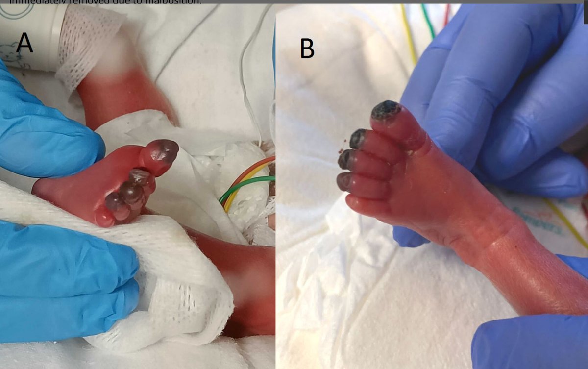 NICU_Musings's tweet image. Distal limb ischemia in a 26 week infant treated with topical nitroglycerin.
Toes saved! Pretty amazing before and after results
pubmed.ncbi.nlm.nih.gov/40589288/
#neoTwitter #dermatology