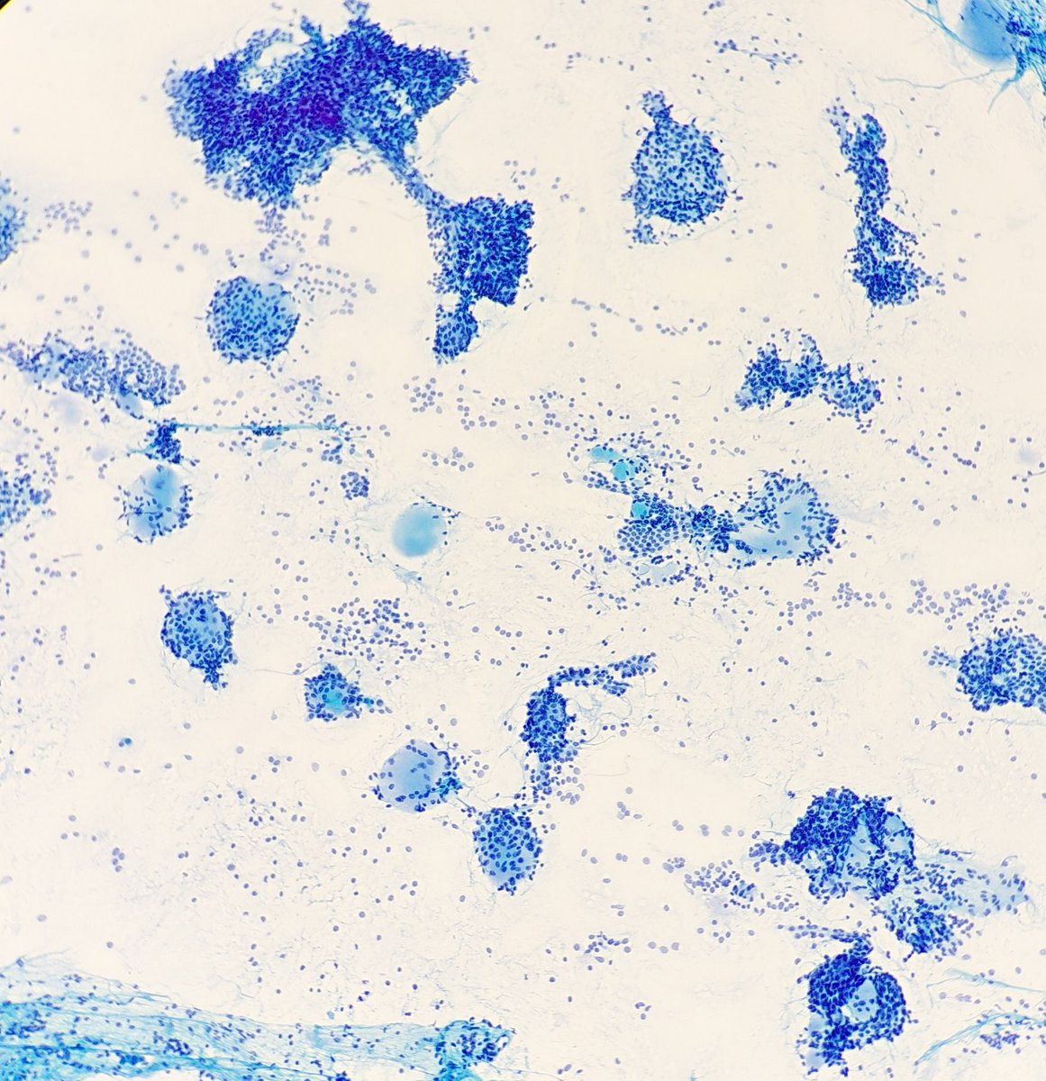 Saroja_DeviG's tweet photo. Pap-stained touch prep from one of the many lung nodules in a patient with a cancer history. Can you guess the primary? 

#PathTwitter #MedTwitter #CytoPath #CytoFellow https://t.co/AXytQGn8l0