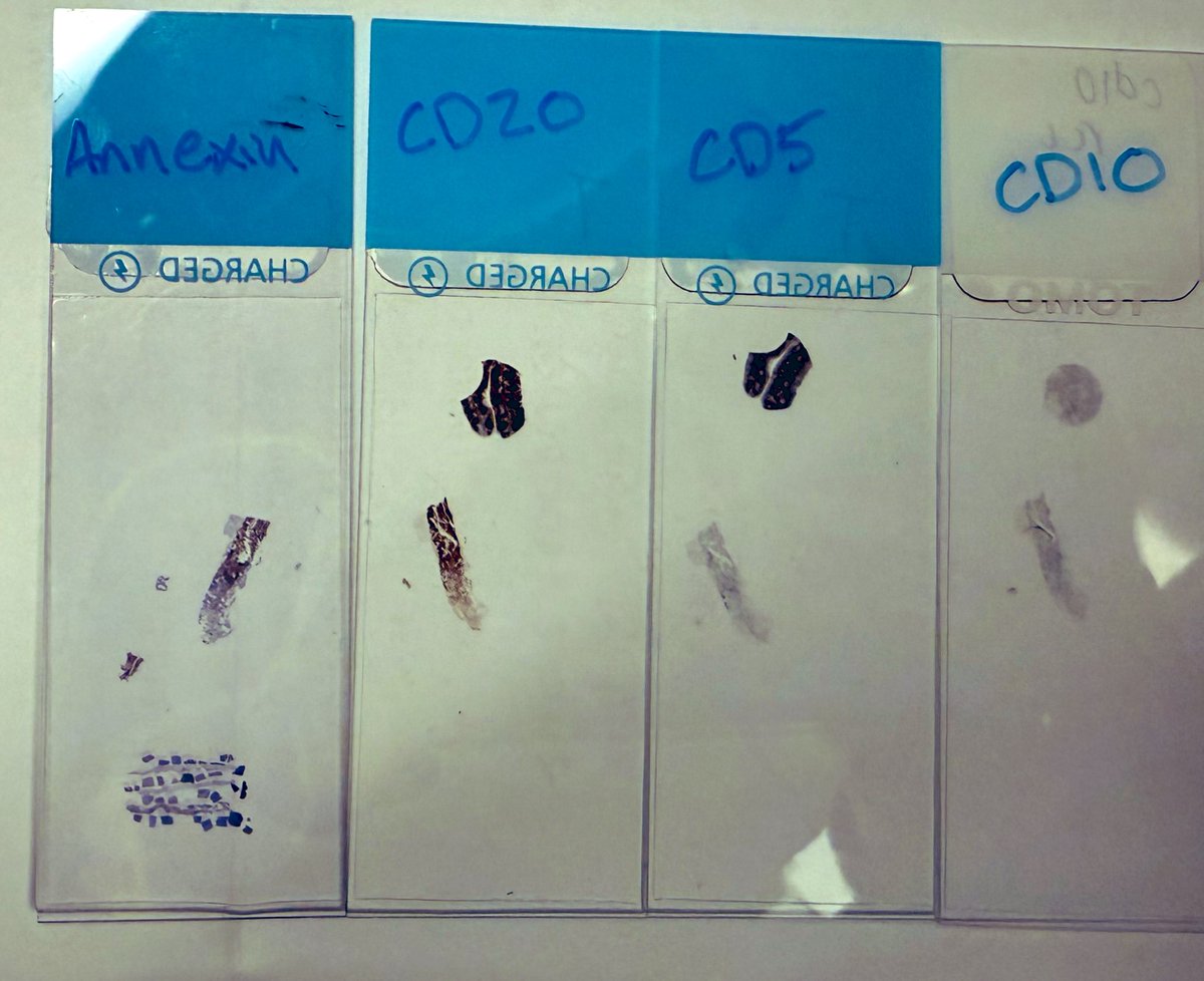 PathologyKate's tweet image. Another #1xdiagnosis. This is a bone marrow biopsy done for cytopenias.
What do you think?