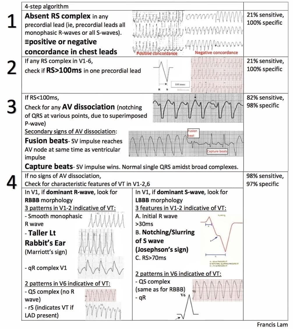 ZHeart11768530's tweet image. 🔴Ventricular Tachycardia (VT) - 4 Step Diagnostic Algorithm⤵️

✅ How can you distinguish a VT from an SVT with aberrant conduction; maybe a little help 👇 
 #ECG #ekg #paramedic #MedstudentTwitter #CardioTwitter #FOAMed #MedEd
#CardioEd #Cardiology #FOAMed #meded #MedEd