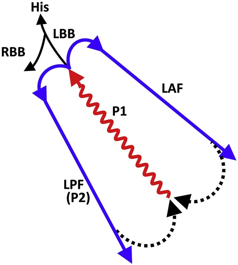 🔴Fascicular Ventricular Tachycardias: Potential Role of the Septal Fascicle⤵️ State-of-the-Art #2023Review #openaccess 

🔹sciencedirect.com/science/articl…
 #Cardiology #FOAMed #MedEd #medstudent #paramedic #Cardiology #CardioEd #medtwitter #meded #CardioTwitter