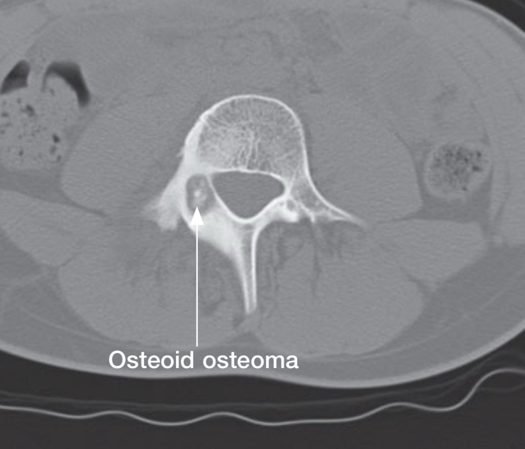 SarMrb's tweet photo. 📸 Abnormal right L4 pedicle on X-ray.
CT: 17 mm lytic lesion with central calc &amp; dense sclerosis.

🧠 Dx: Osteoblastoma (vs. osteoid osteoma)

🎯 Pearl: Chronic back pain relieved by aspirin?
Think osteoid osteoma / osteoblastoma — esp. in young men. https://t.co/CURAIJNb0R