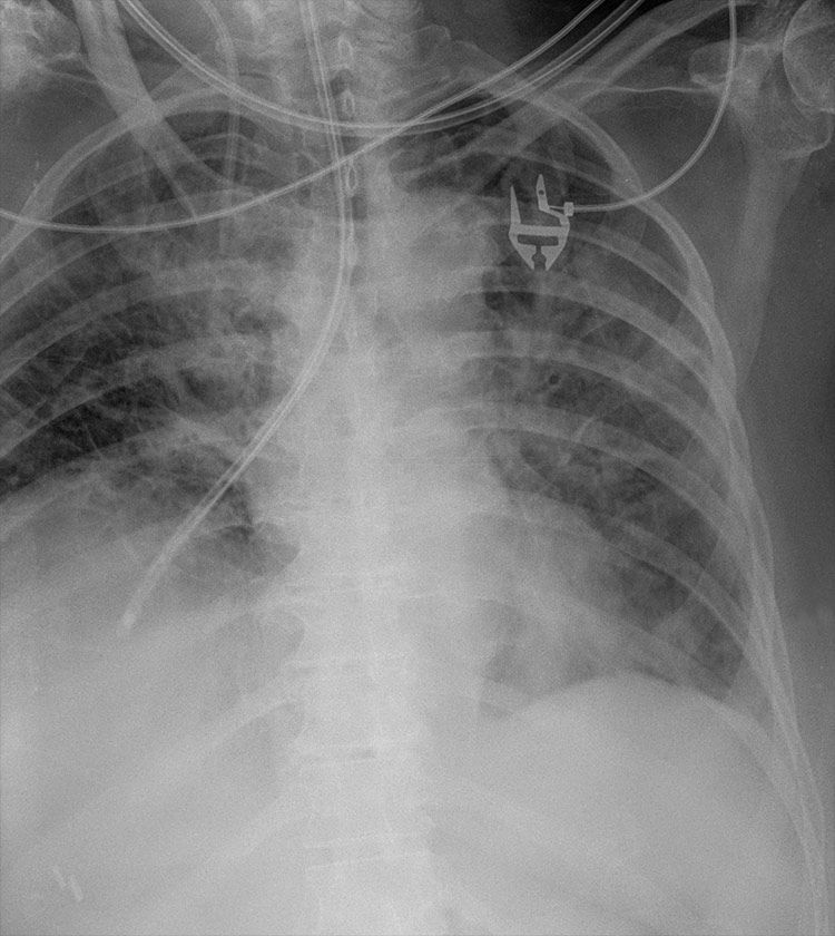 X-RAY QUIZ: Nasogastric tube insertion. Failed to aspirate gastric fluid. Where is the nasogastric tube tip?
A: Stomach
B: Within a hiatus hernia
C: Right upper quadrant of abdomen
D: Right side of mediastinum
E: Right lung
Annotations slide 2. Start Quiz buff.ly/4arT87t