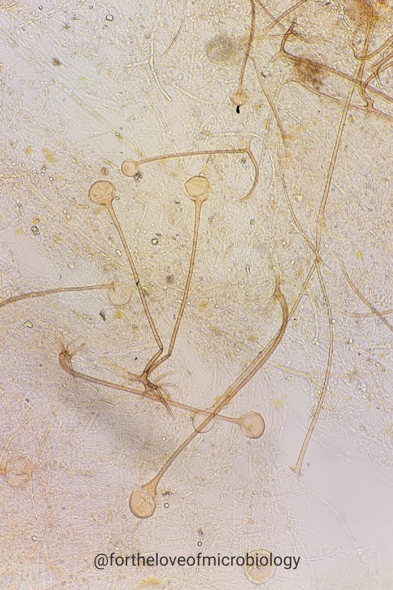 fortheloveofmi2's tweet photo. 🔬 KOH Mount – Nasal Scraping
A rare and striking view of Rhizopus in full sporulation — directly from a clinical sample!

This image captures classic microscopic features of Rhizopus, a member of the Mucorales order and a known agent of mucormycosis. Under the microscope, you can clearly see:

✔️ Sporangiophores – upright stalks bearing sporangia
✔️ Sporangia – round, spore-filled sacs at the tips of sporangiophores
✔️ Rhizoids – root-like structures at the base, typically found opposite the sporangiophores (a key feature distinguishing Rhizopus from other genera like Mucor)

These morphological features are diagnostic and provide rapid presumptive identification on direct microscopy — crucial for initiating timely antifungal therapy.

🧫 Stain: 10% KOH
📍 Sample: Nasal scraping
📸 @fortheloveofmicrobiology

#Microbiology #MedicalMycology #Mucormycosis #Rhizopus #KOHMount #InfectiousDiseases #LabLife #ClinicalMicrobiology #Microscopy #IDMed #Fungus

#Fortheloveofmicrobiology #clinicalmicrobiology #mmidsp #microrounds #IDpath #ASMClinMicro #STEM #WomeninMicrobiology #ClinMicro #microbiologypakistan #PathBugs #crittersontwitter