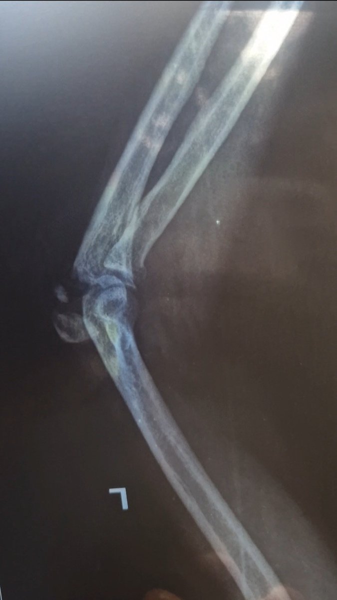 Adaka47's tweet image. Hey X fam, I really need your help.
I&apos;m urgently looking for an orthopedic surgeon willing to perform pro bono (free) surgery on my elbow. The pain is constant, and it&apos;s affecting my daily life in a big way.

If you know any doctors, hospitals, or programs that offer..