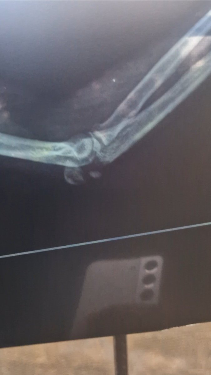 Adaka47's tweet image. Hey X fam, I really need your help.
I&apos;m urgently looking for an orthopedic surgeon willing to perform pro bono (free) surgery on my elbow. The pain is constant, and it&apos;s affecting my daily life in a big way.

If you know any doctors, hospitals, or programs that offer..