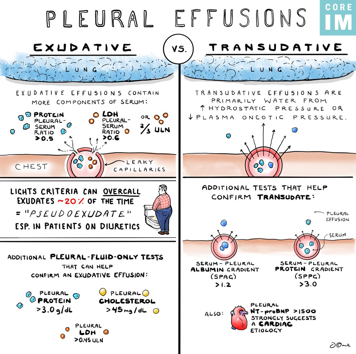 PulmPEEPs's tweet image. We can't get enough of pleural effusions!! We were so excited to go on @COREIMpodcast to discuss some pearls around pleural effusion diagnosis and management.
If you want more, check out our episodes on effusions, empyema, and malignant effusions!
pulmpeeps.com/2025/07/09/104…