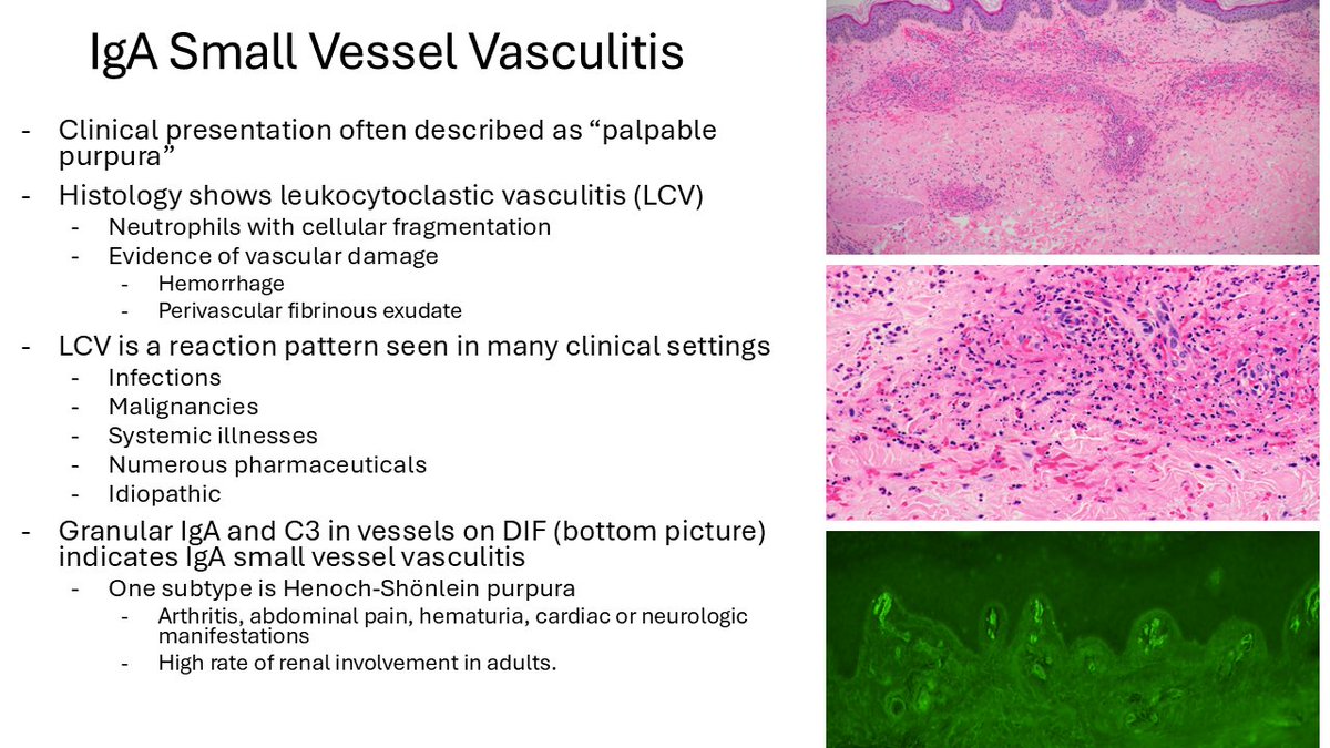 TheJPCNCR's tweet image. IgA Small Vessel Vasculitis #TheJPCNCR #PathTwitter