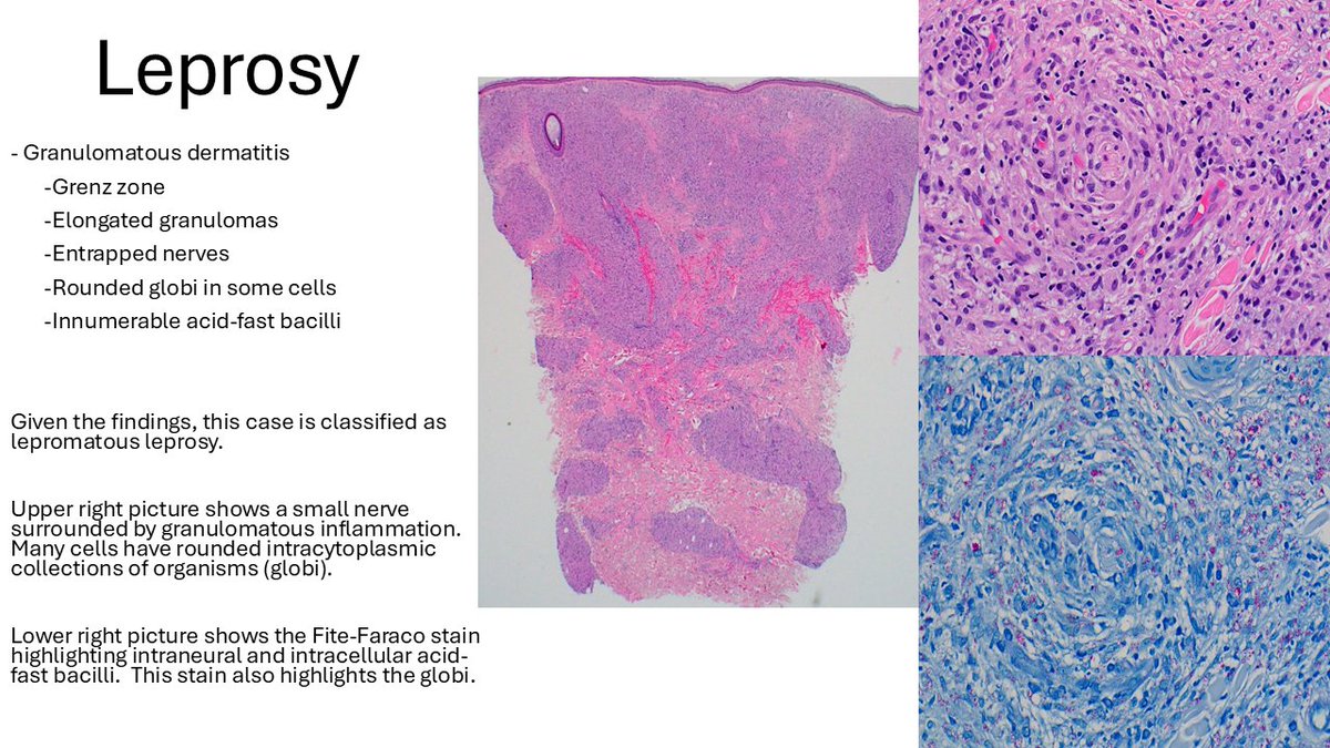 TheJPCNCR's tweet image. Leprosy #TheJPCNCR #PathTwitter