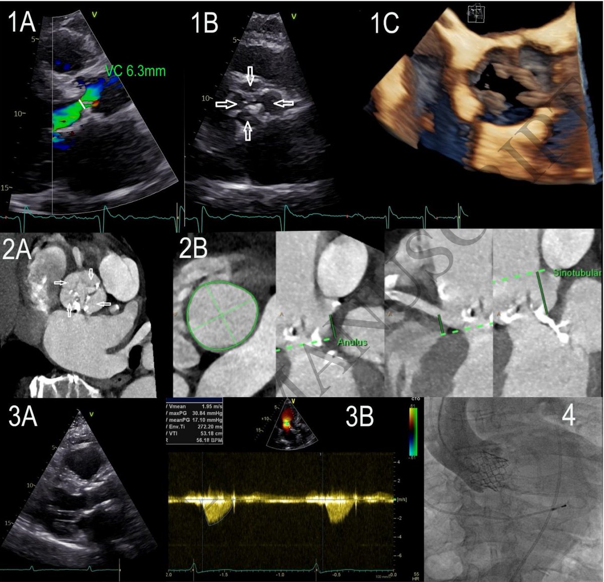 Vladyslav Kavalerchyk 🇺🇦 (@echo_stepbystep) on Twitter photo Multimodal Imaging in Quadricuspid Aortic Valve Regurgitation & Stenosis: Diagnostic Challenges before TAVR
Accepted <a href="/EHJIMPEiC/">EHJ-IMP Editor-in-Chief</a> 🎉
By Louise Sakowski & <a href="/echo_stepbystep/">Vladyslav Kavalerchyk 🇺🇦</a>
📄 doi.org/10.1093/ehjimp…
<a href="/alessia_gimelli/">Alessia Gimelli</a> <a href="/iamritu/">Ritu Thamman MD</a> <a href="/JGrapsa/">Julia Grapsa MD, PhD</a> <a href="/EZancanaroMD/">Edoardo Zancanaro MD</a> <a href="/dr_benoy_n_shah/">Benoy Shah MD</a> <a href="/alexsfelixecho/">Alex Felix</a> Multimodal Imaging in Quadricuspid Aortic Valve Regurgitation & Stenosis: Diagnostic Challenges before TAVR
Accepted <a href="/EHJIMPEiC/">EHJ-IMP Editor-in-Chief</a> 🎉
By Louise Sakowski & <a href="/echo_stepbystep/">Vladyslav Kavalerchyk 🇺🇦</a>
📄 doi.org/10.1093/ehjimp…
<a href="/alessia_gimelli/">Alessia Gimelli</a> <a href="/iamritu/">Ritu Thamman MD</a> <a href="/JGrapsa/">Julia Grapsa MD, PhD</a> <a href="/EZancanaroMD/">Edoardo Zancanaro MD</a> <a href="/dr_benoy_n_shah/">Benoy Shah MD</a> <a href="/alexsfelixecho/">Alex Felix</a>