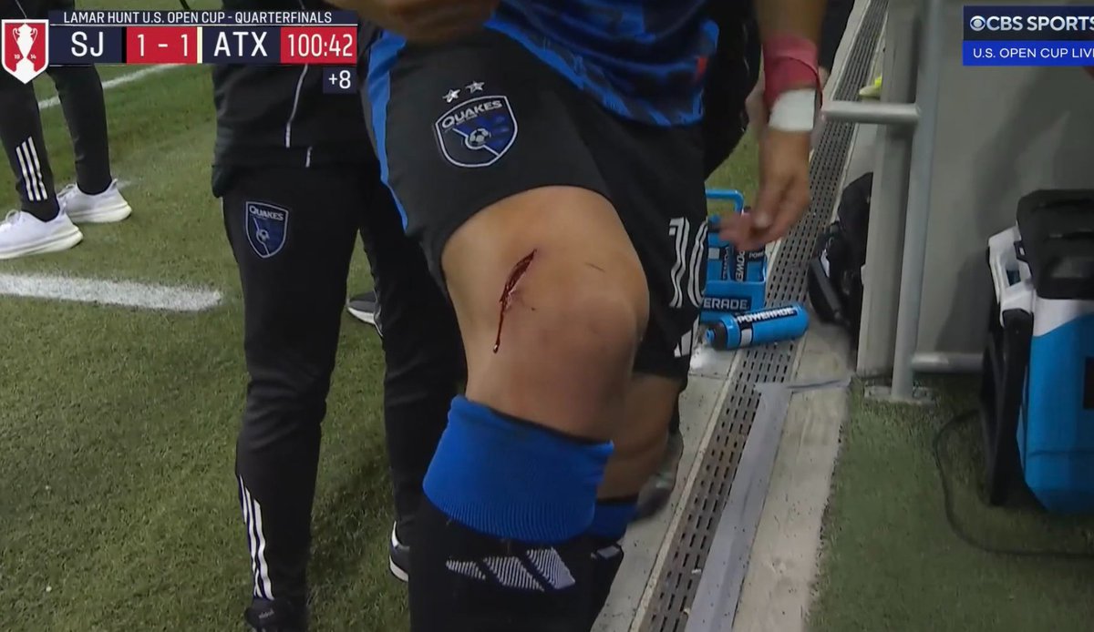 FavianRenkel's tweet photo. Bruce Arena on Cristian Espinoza having to leave the game after a challenge resulted in a large gash over his right knee and a yellow card for Austin FC defender Mikkel Desler:

“I know he needed to get stitches. The foul on him was a straight red card.”

#USOpenCup #Quakes74 @usopencup