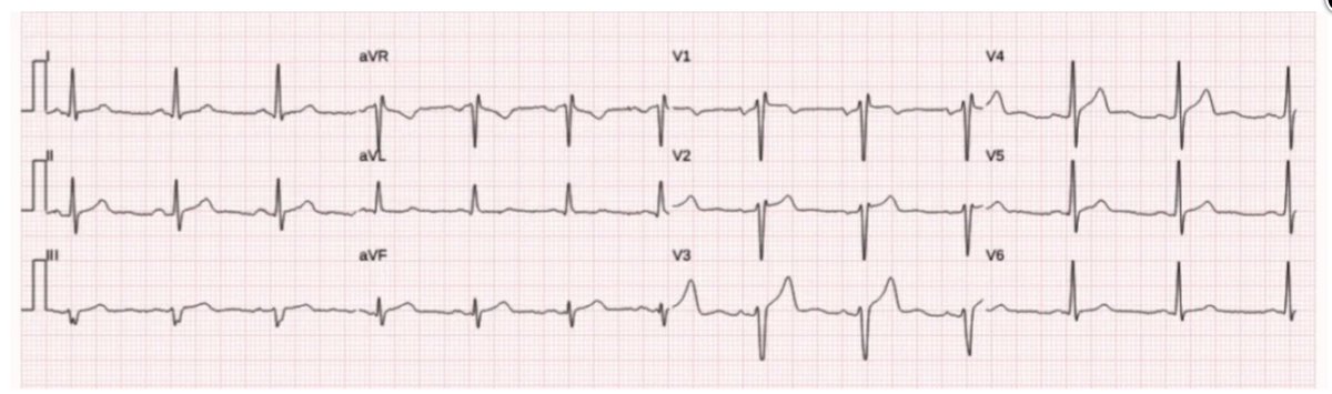 Stephen W. Smith (@smithecgblog) on Twitter photo Back to basics: ECGs are dynamic, get serial ECGs and learn the OMI progression
drsmithsecgblog.com/back-to-basics…
<a href="/PendellM/">Pendell Meyers</a> Back to basics: ECGs are dynamic, get serial ECGs and learn the OMI progression
drsmithsecgblog.com/back-to-basics…
<a href="/PendellM/">Pendell Meyers</a>