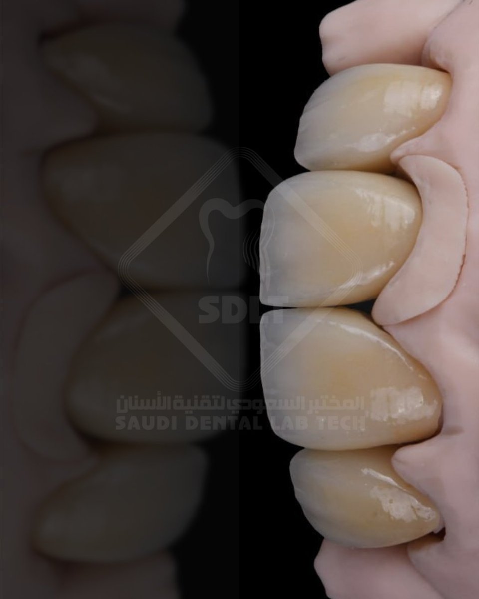 من حالات التجميل التي تجمع بين التيجان وزراعة الأسنان 💫
#زراعة_اسنان #معمل_اسنان #Dentist